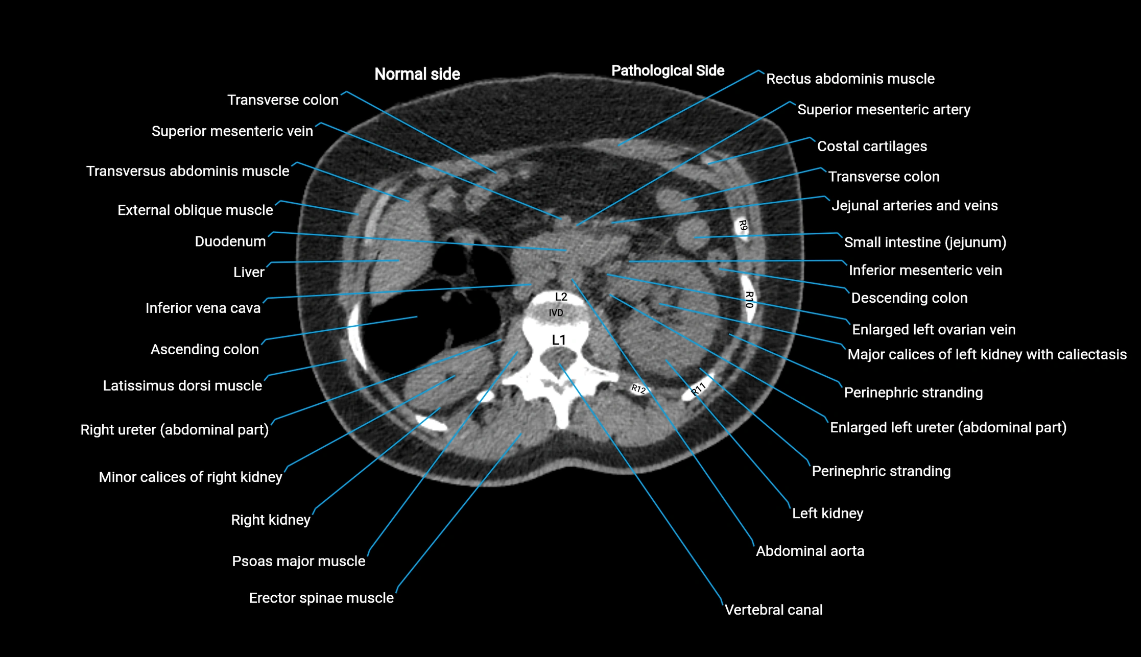 CT KUB axial cross sectional anatomy  radiology image -img-00201-00047.webp
